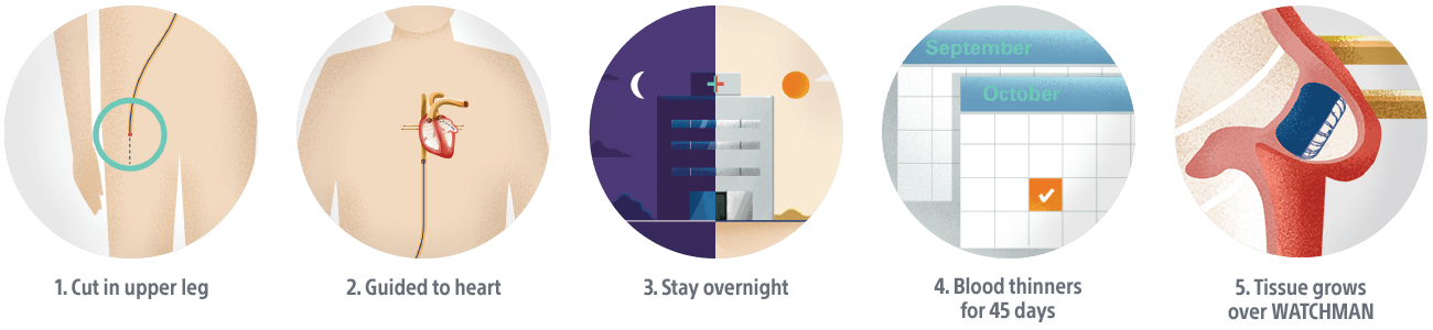 WATCHMAN procedure steps