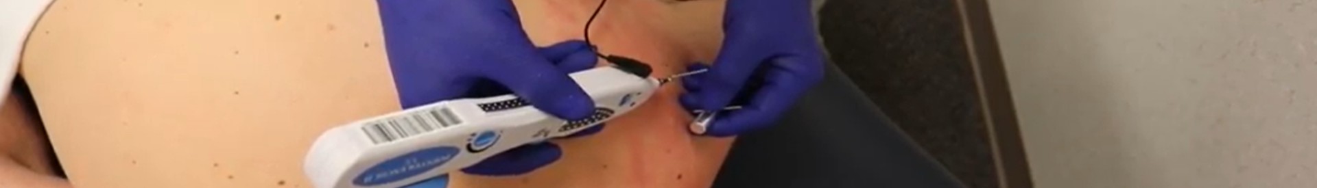 Dry Needling